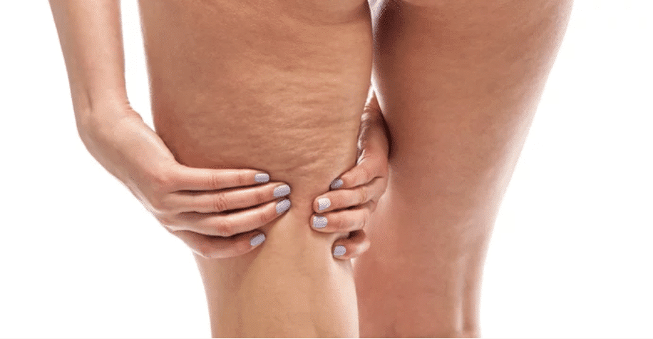 2x Cellulite PRO